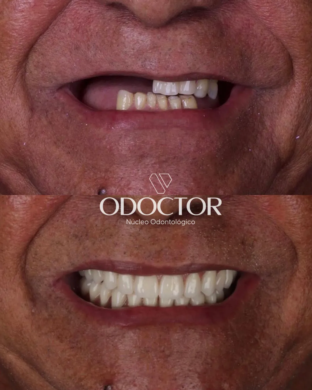 Antes e depois de prótese na Odoctor