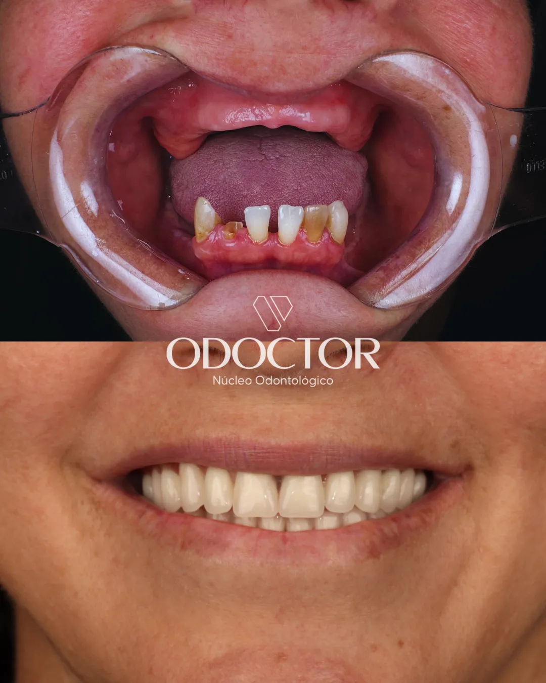 Antes e depois de implantes na Odoctor