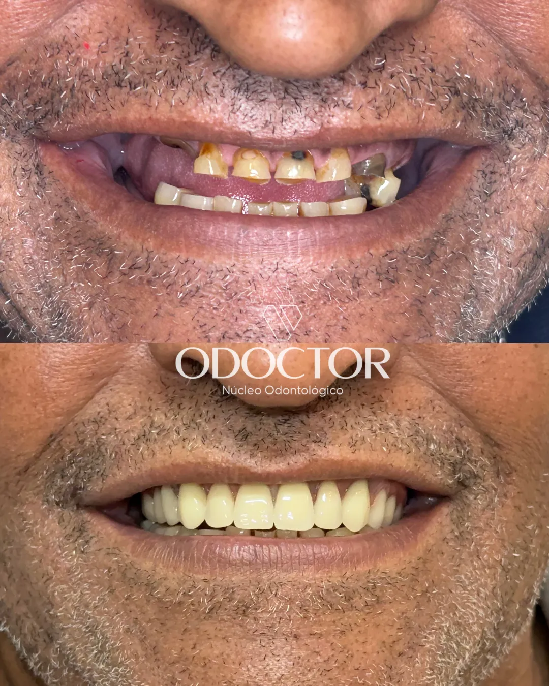 Antes e depois de prótese na Odoctor