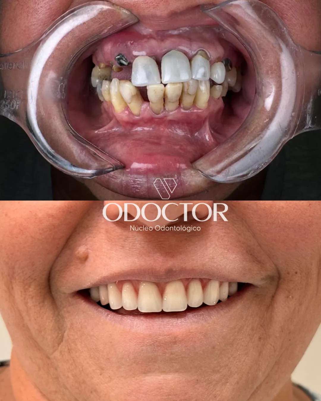 Antes e depois de implantes na Odoctor