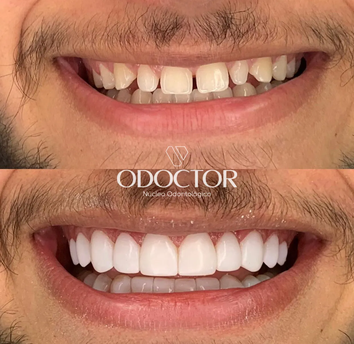 O que são lentes e facetas