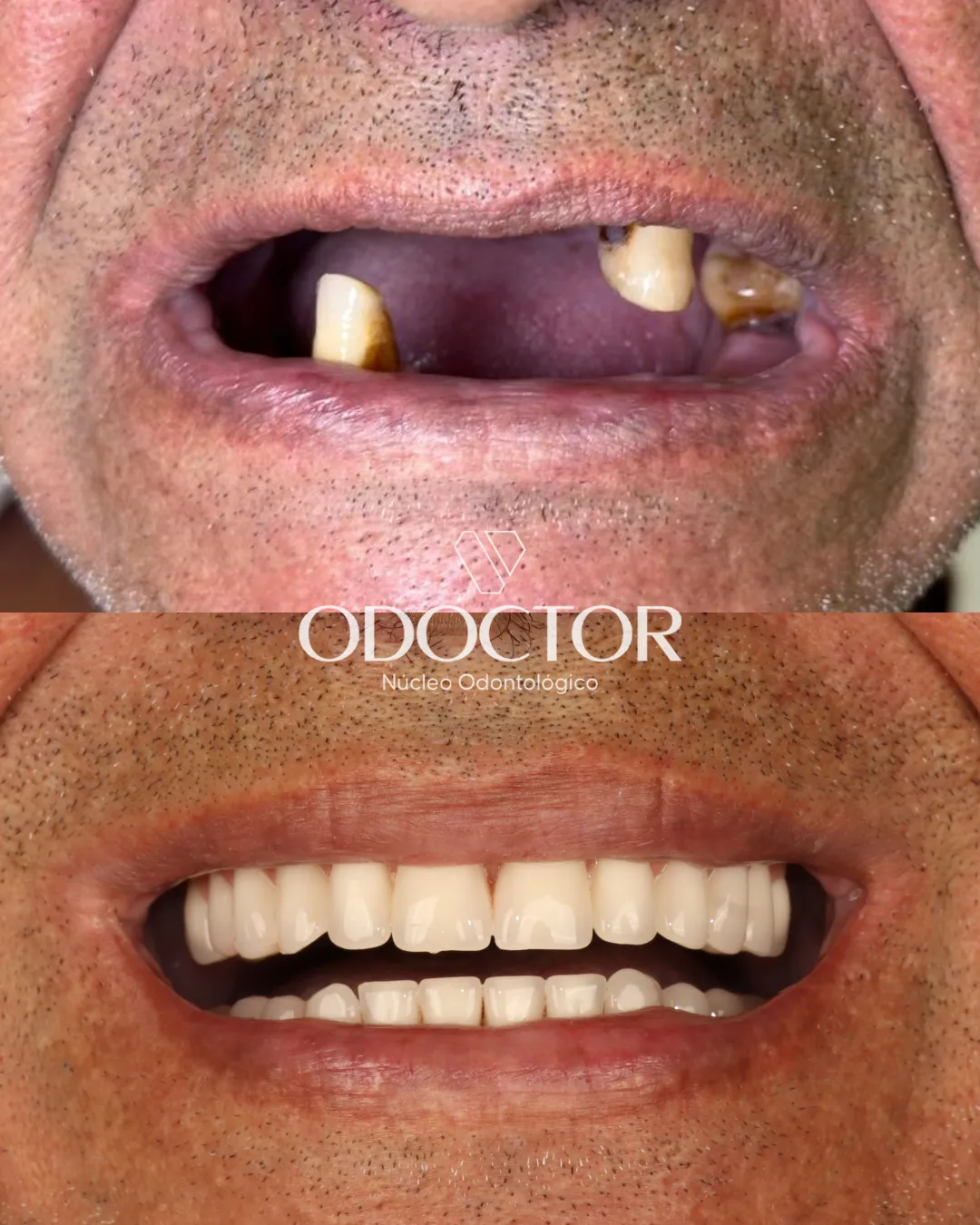 Antes e depois de próteses na Odoctor
